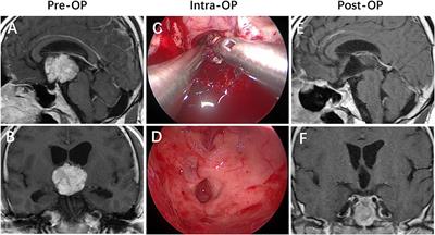 Clinical Analysis of Risk Factors of Postoperative Psychiatric Disorders in Patients With Adult Craniopharyngioma